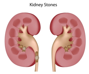 kidney-stone-symptoms